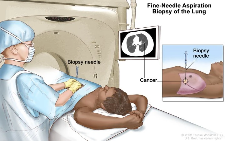 Fine Needle Aspiration Procedure Illustration Fine Needle Aspiration Procedure Illustration